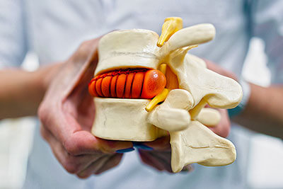 Bandscheibenvorfall Model Wirbelsäule in der Hand eines Radiologen